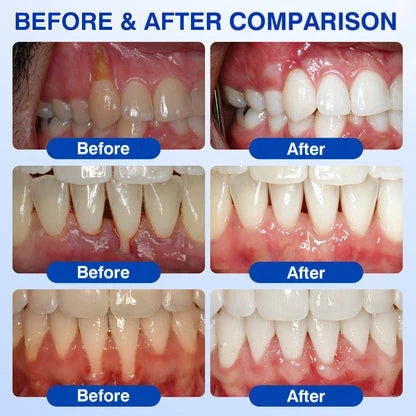 🧑‍⚕️GRUNSIFY Periodontal Care Gel