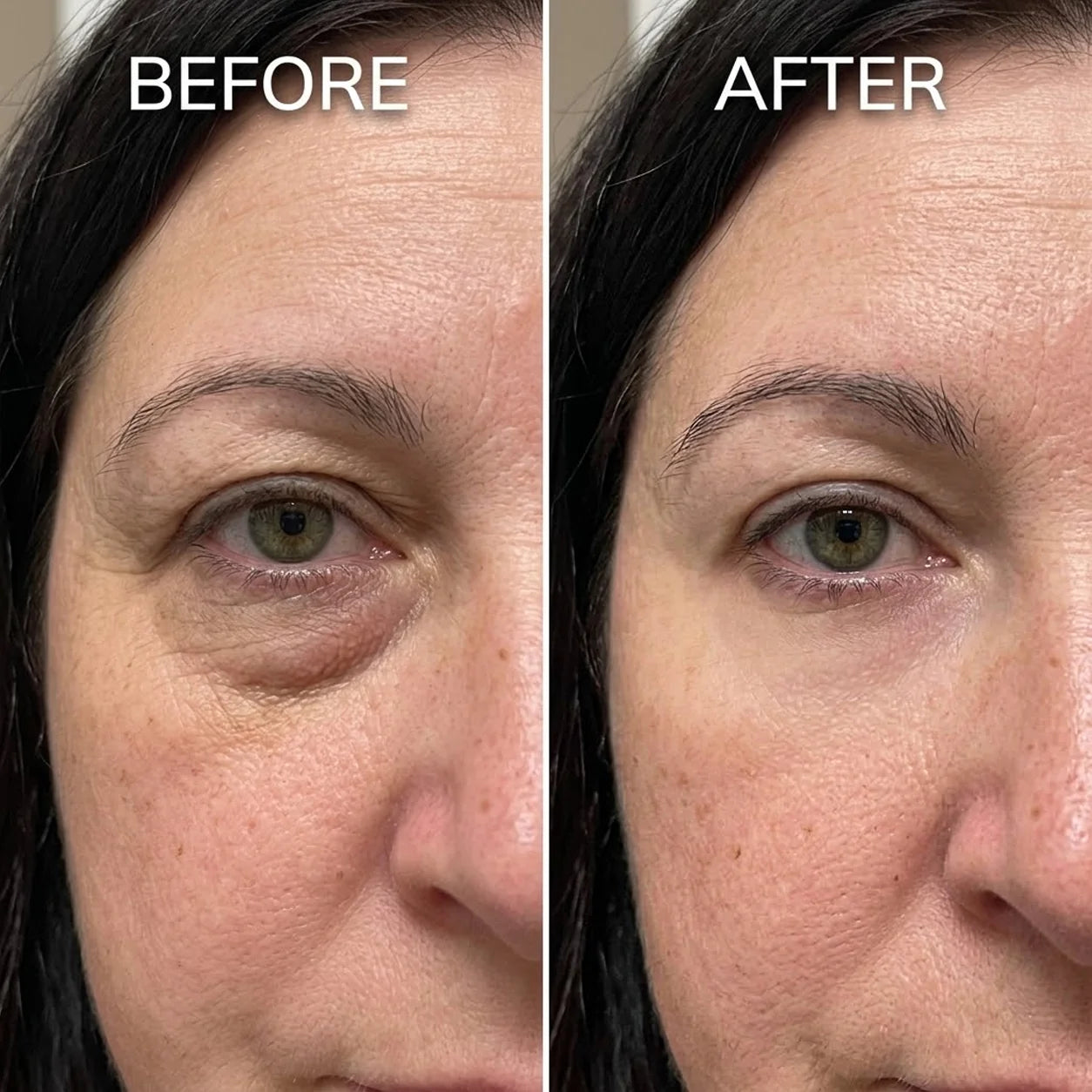 HZA under-eye bag before and after appearance example